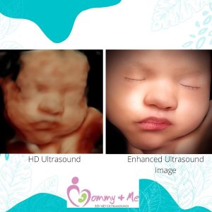 8K enhanced image ultrasound