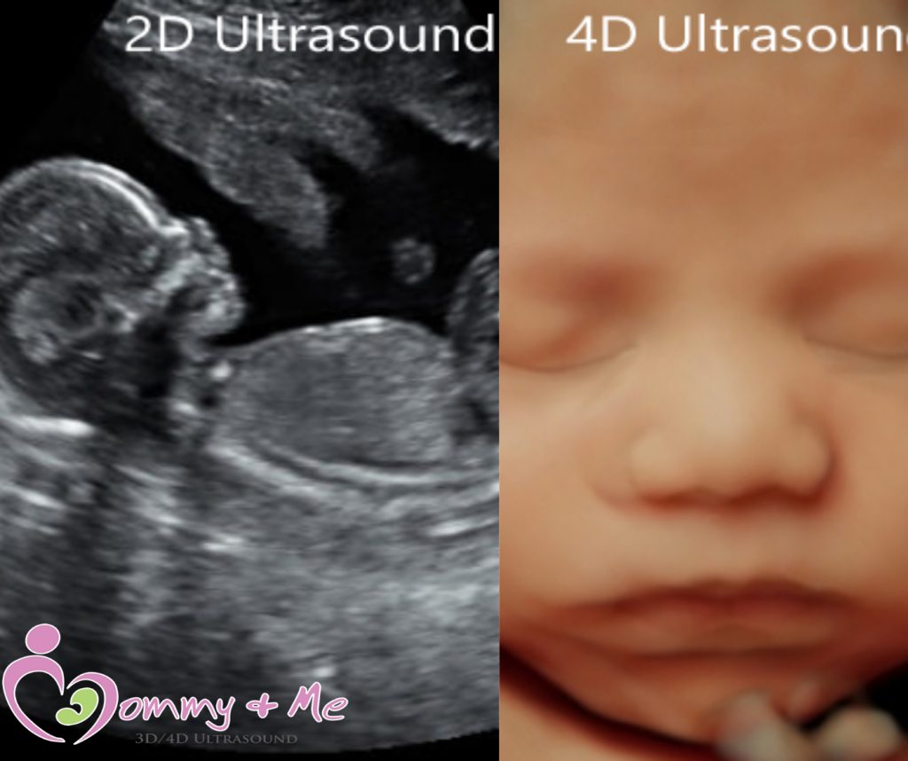 3D/4D Ultrasound, Benefits of a 6-Week Ultrasound
